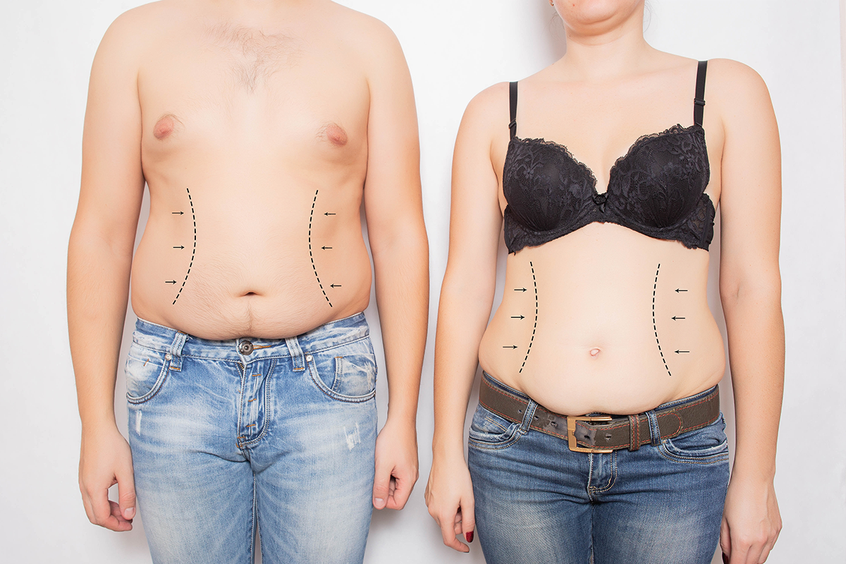 man and woman overweight and obese on his stomach