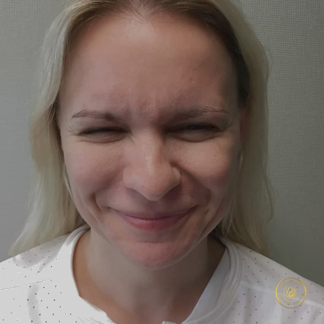 botox after photo by michigan cosmetic surgery in southfield mi