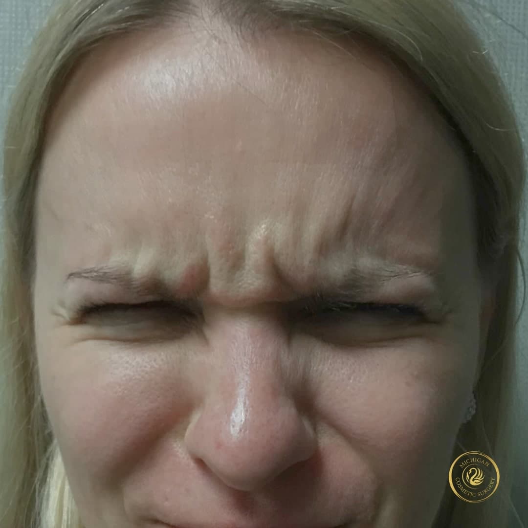 botox before photo by michigan cosmetic surgery in southfield mi