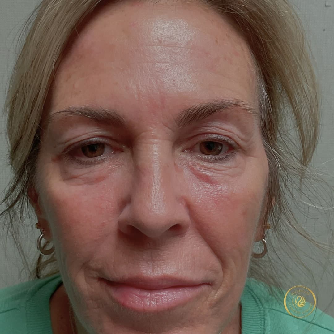 botox before photo by michigan cosmetic surgery in southfield mi