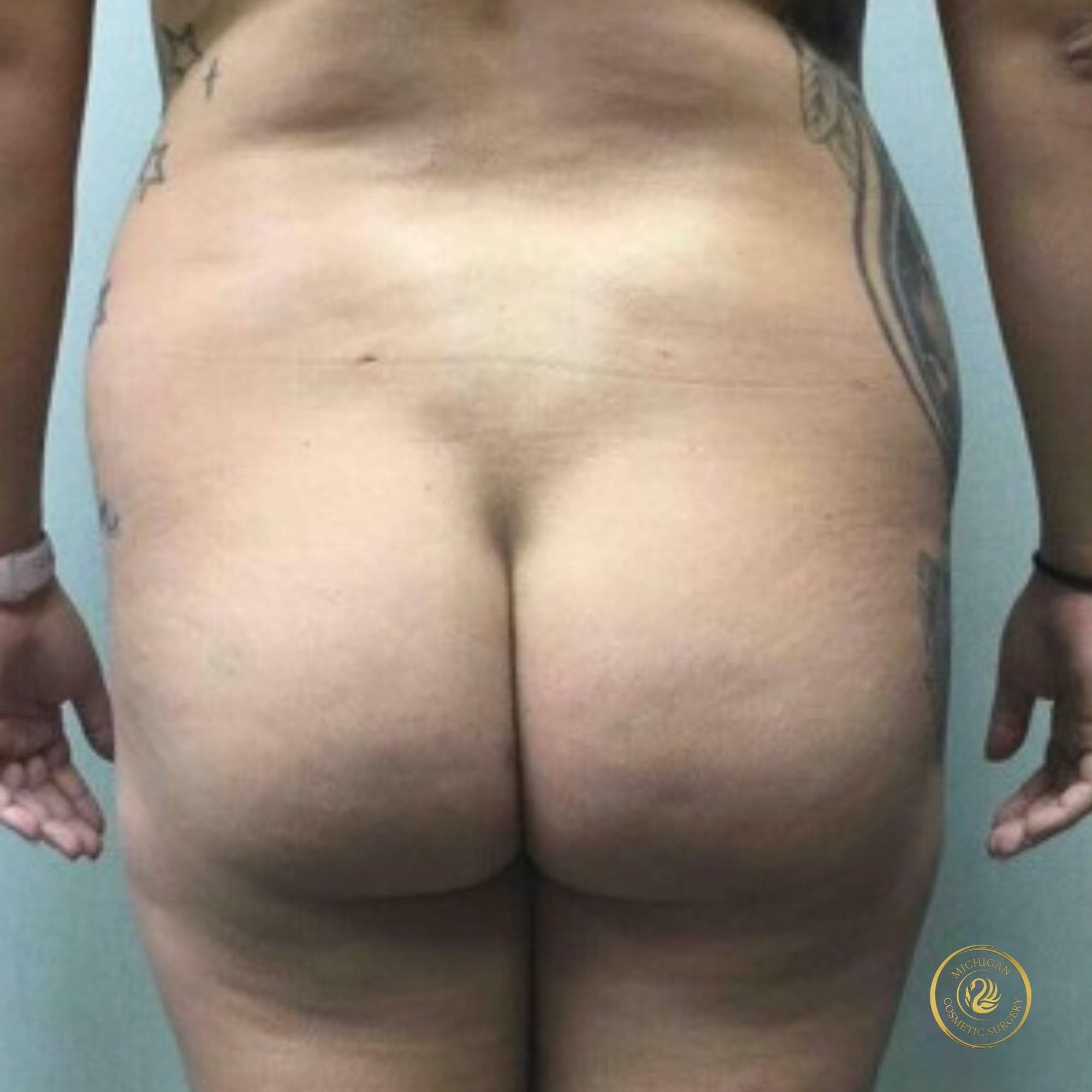 brazilian butt lift before photo by michigan cosmetic surgery in southfield mi