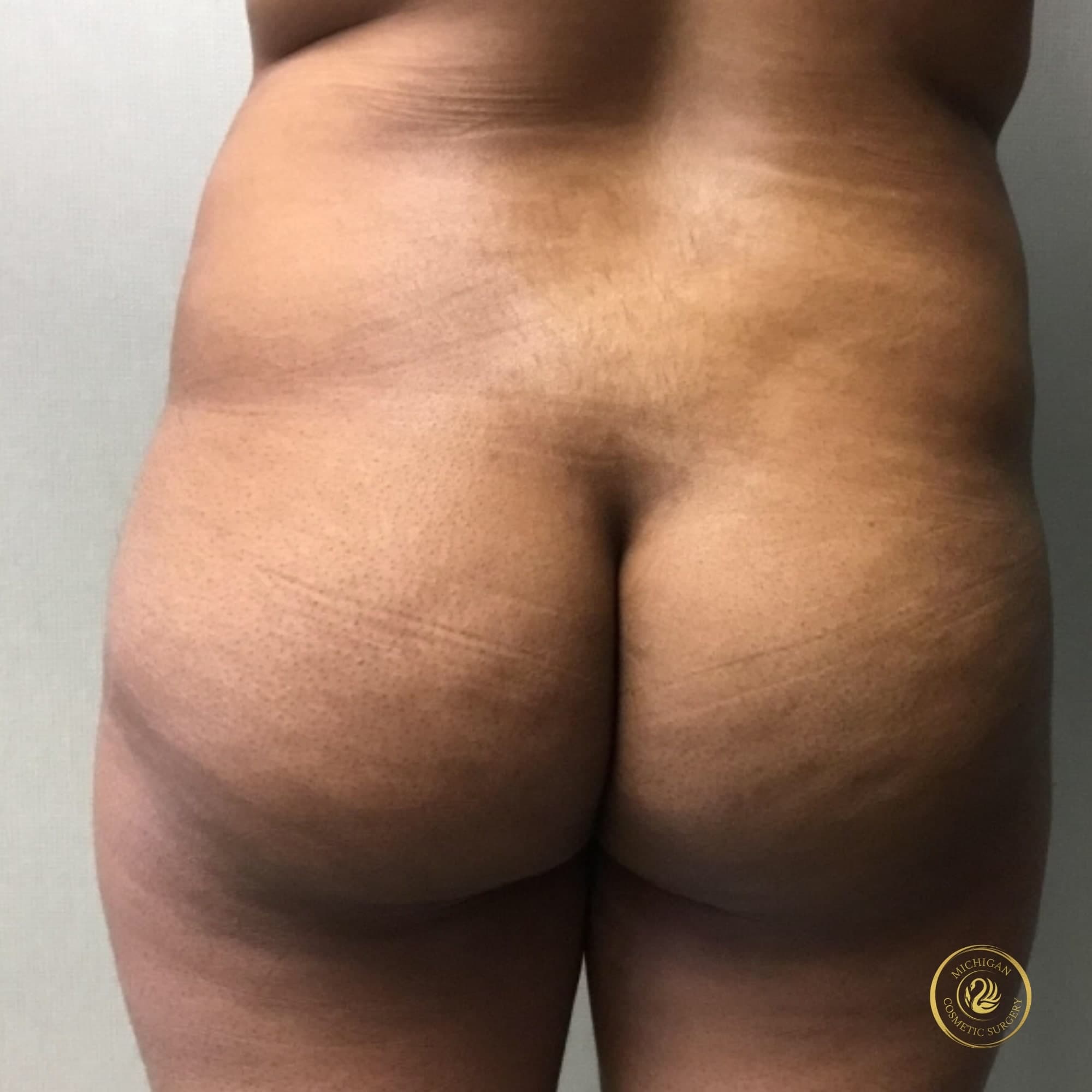 brazilian butt lift before photo by michigan cosmetic surgery in southfield mi