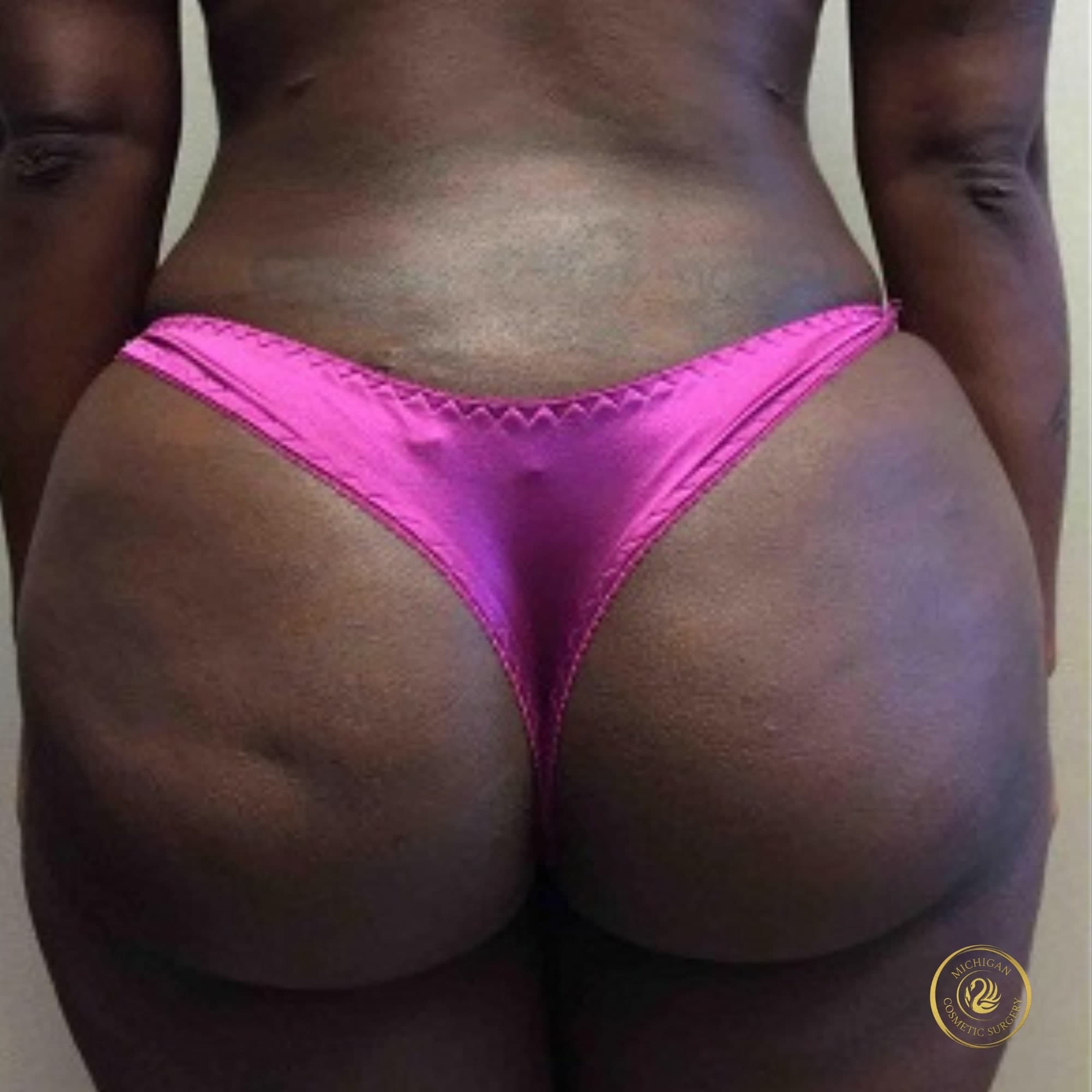 brazilian butt lift after photo by michigan cosmetic surgery in southfield mi