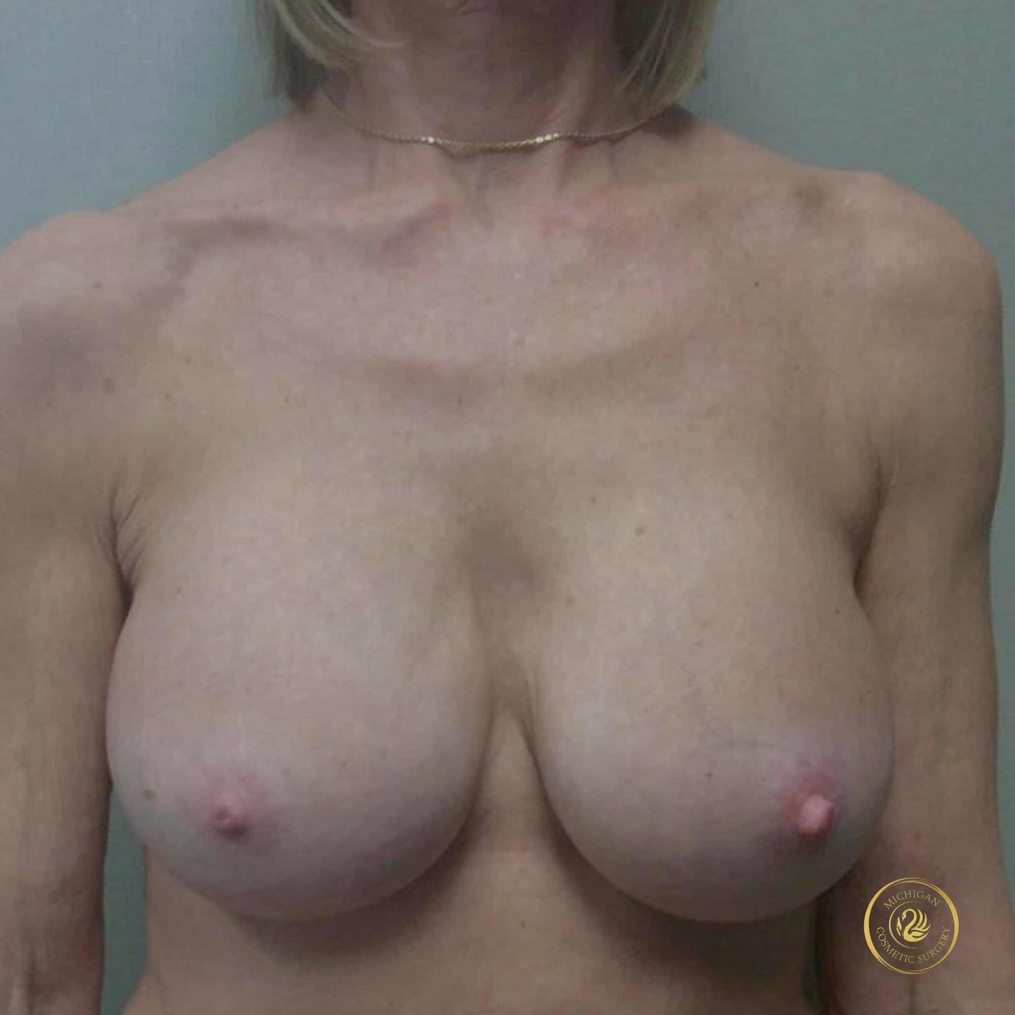breast implant exchange removal before photo by michigan cosmetic surgery in southfield mi