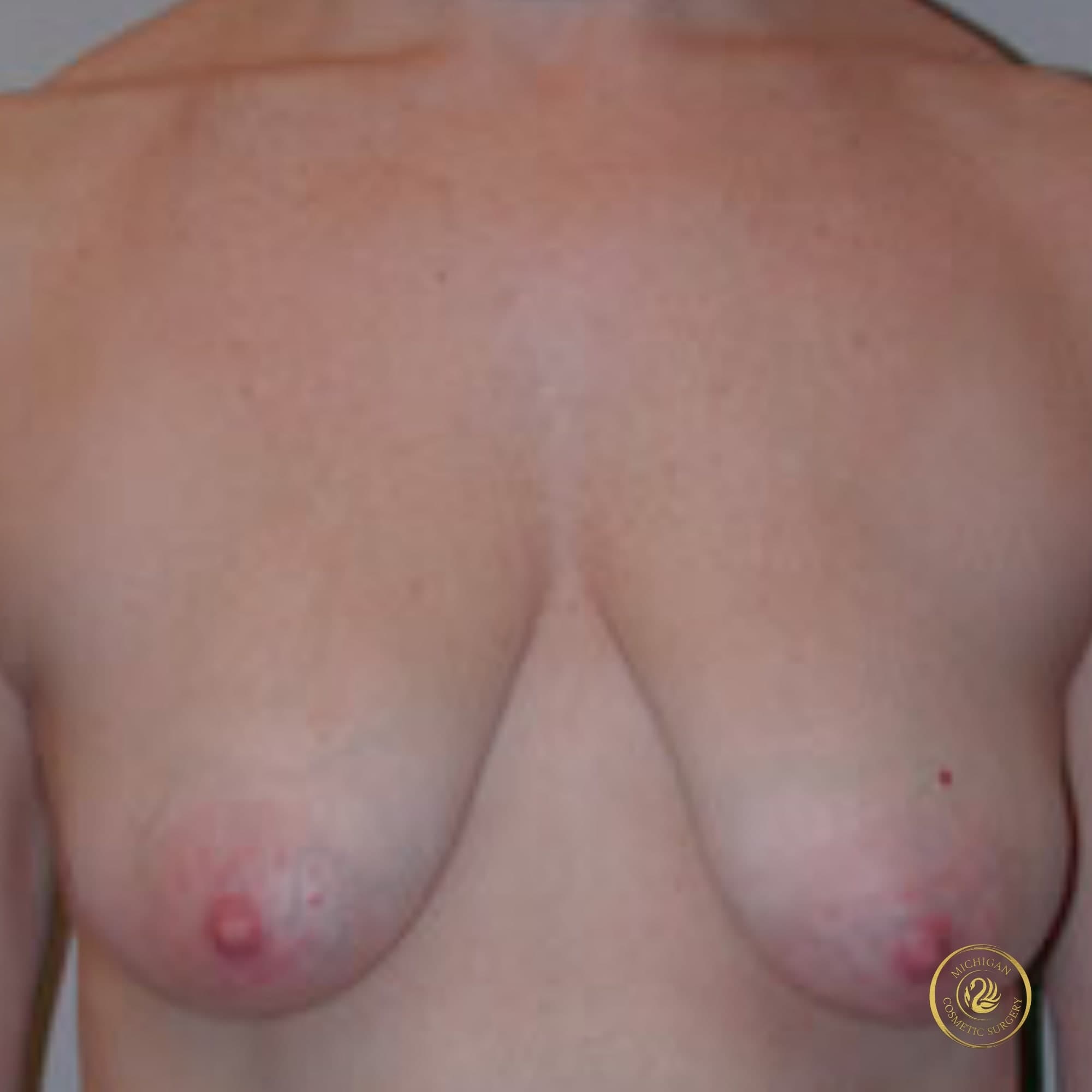 breast lift before photo by michigan cosmetic surgery in southfield mi