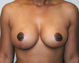 breast reduction after photo by michigan cosmetic surgery in southfield mi