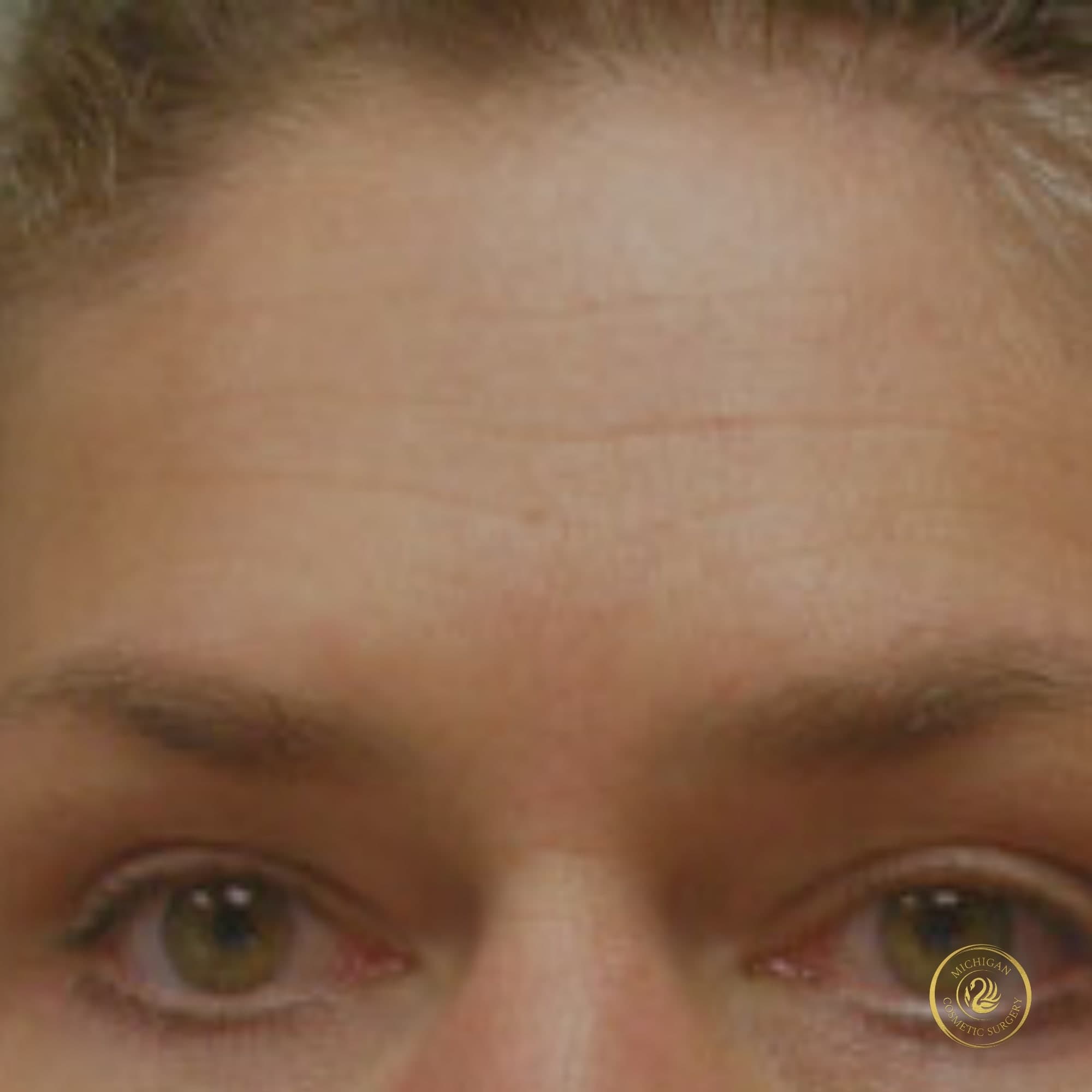 brow lift after photo by michigan cosmetic surgery in southfield mi