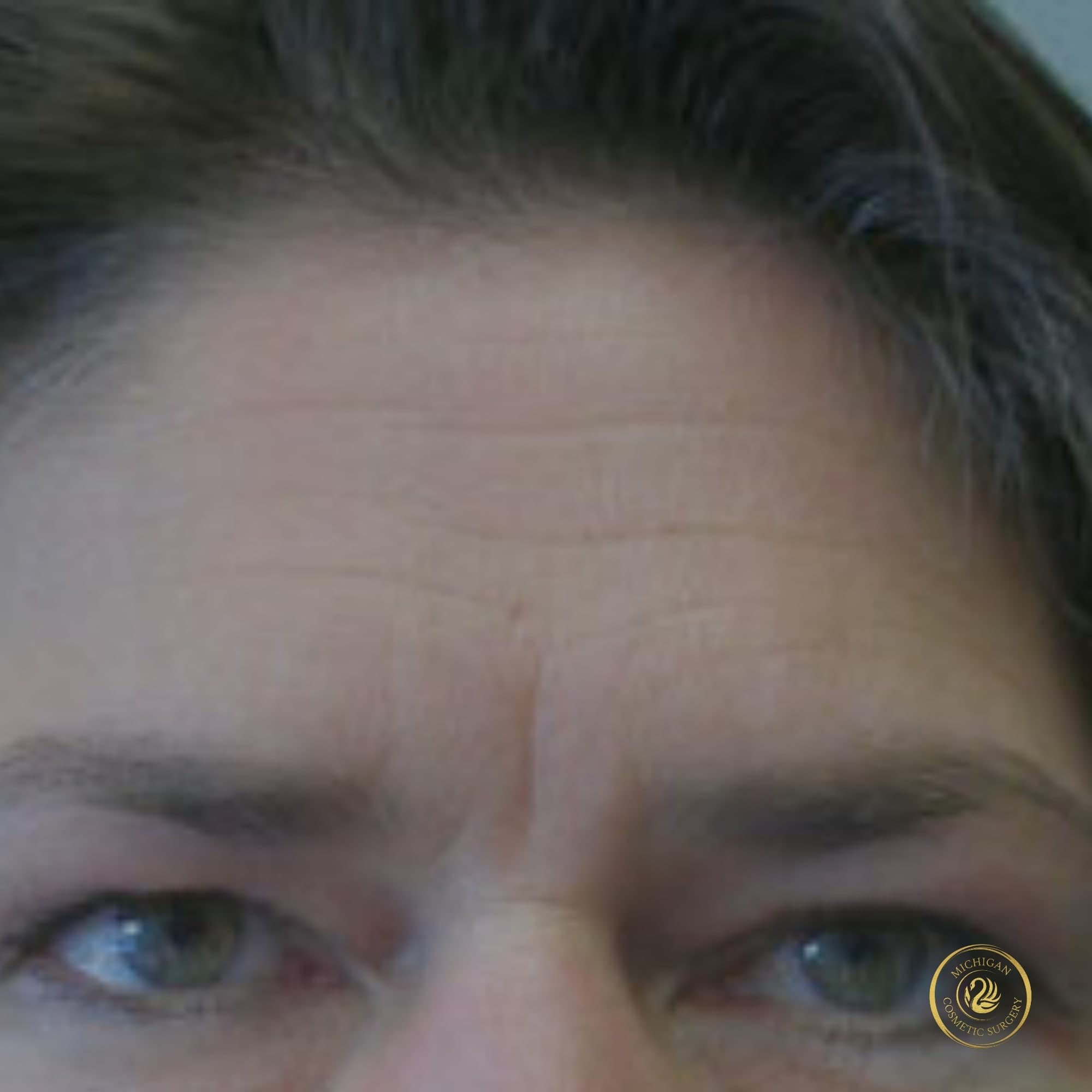 brow lift before photo by michigan cosmetic surgery in southfield mi
