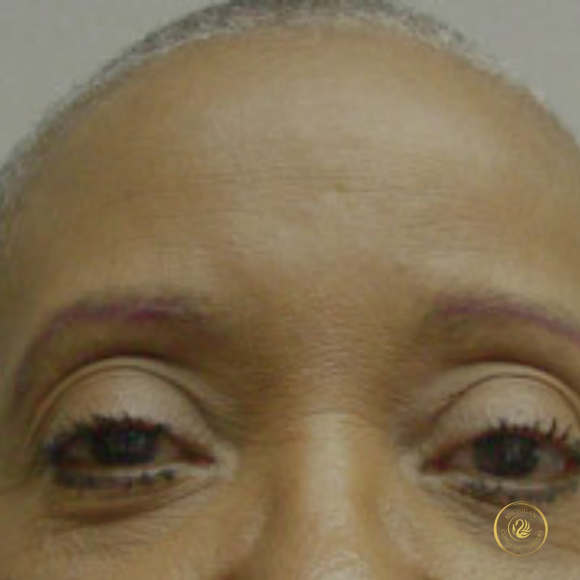 brow lift after photo by michigan cosmetic surgery in southfield mi