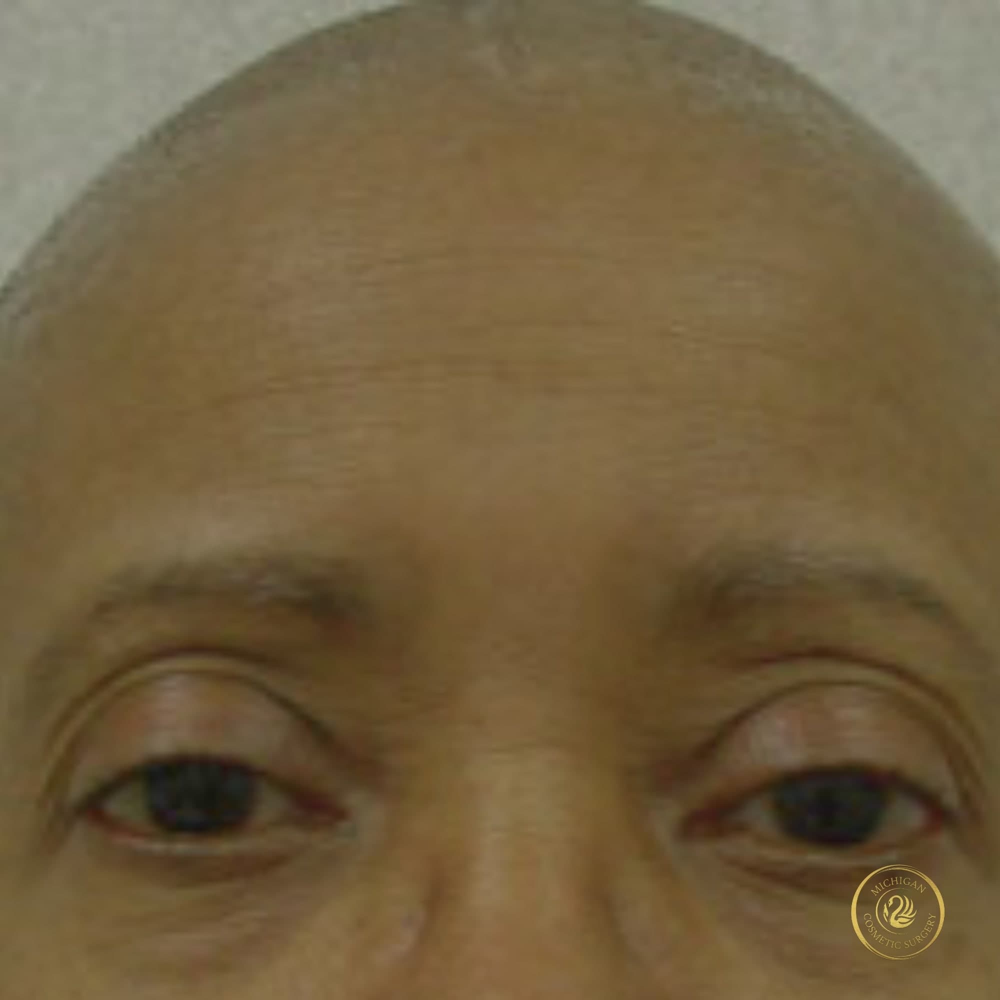 brow lift before photo by michigan cosmetic surgery in southfield mi