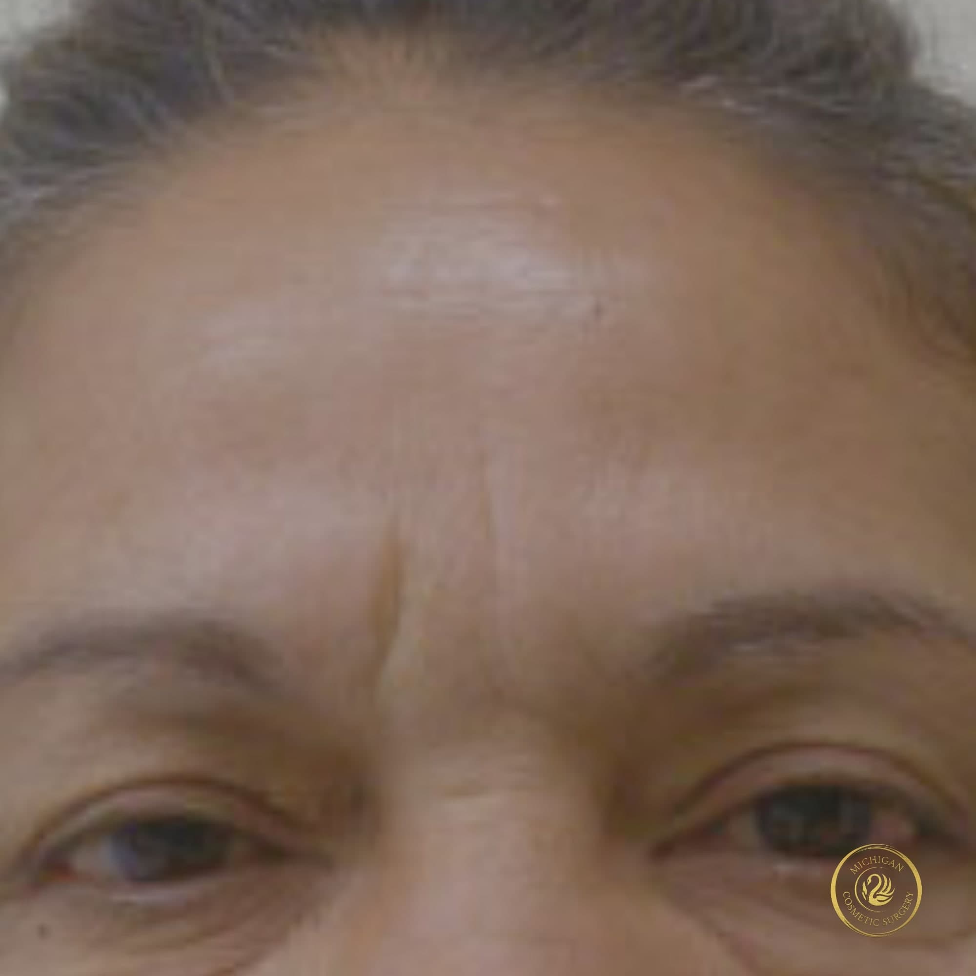 brow lift before photo by michigan cosmetic surgery in southfield mi