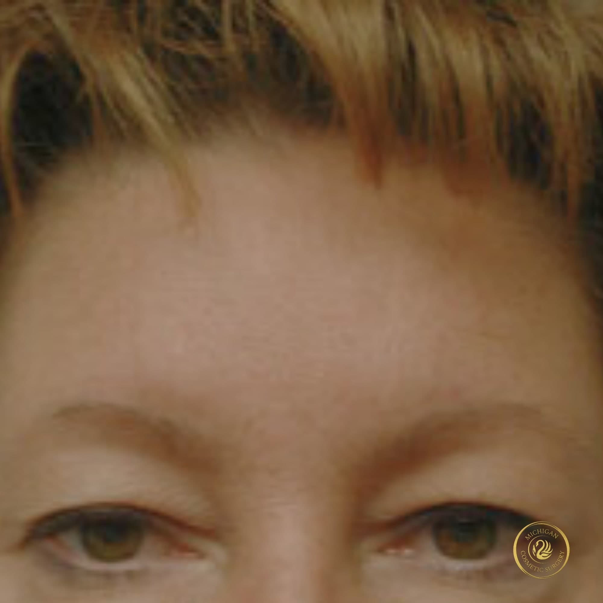brow lift before photo by michigan cosmetic surgery in southfield mi