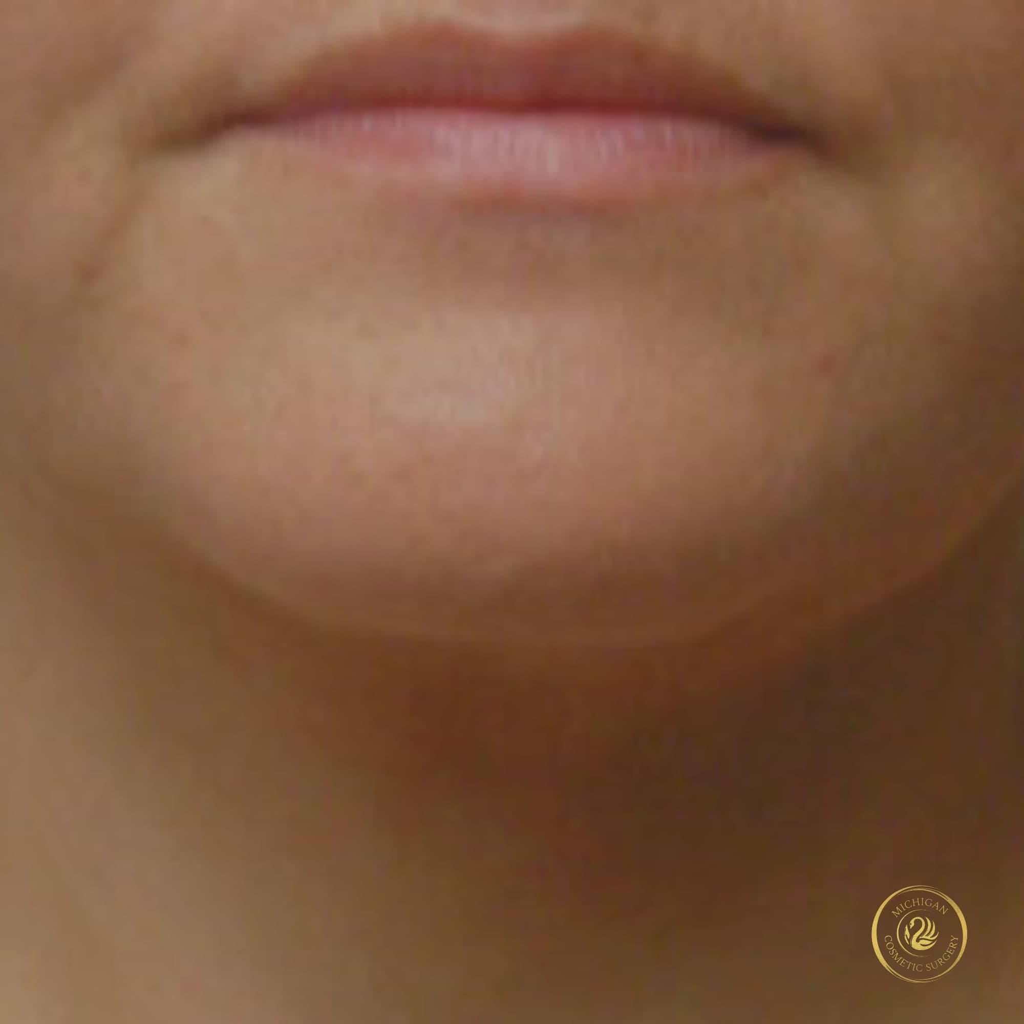 chin liposuction after photo by michigan cosmetic surgery in southfield mi
