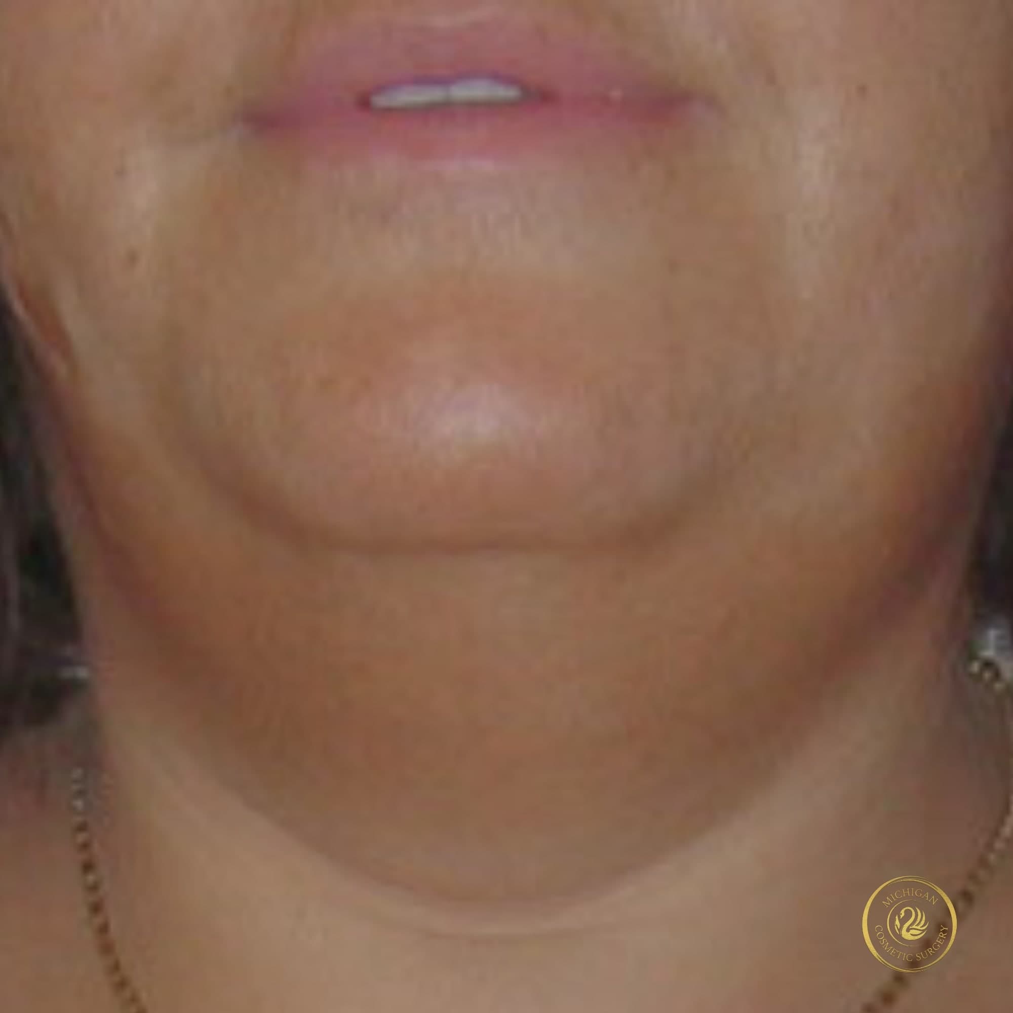 chin liposuction before photo by michigan cosmetic surgery in southfield mi