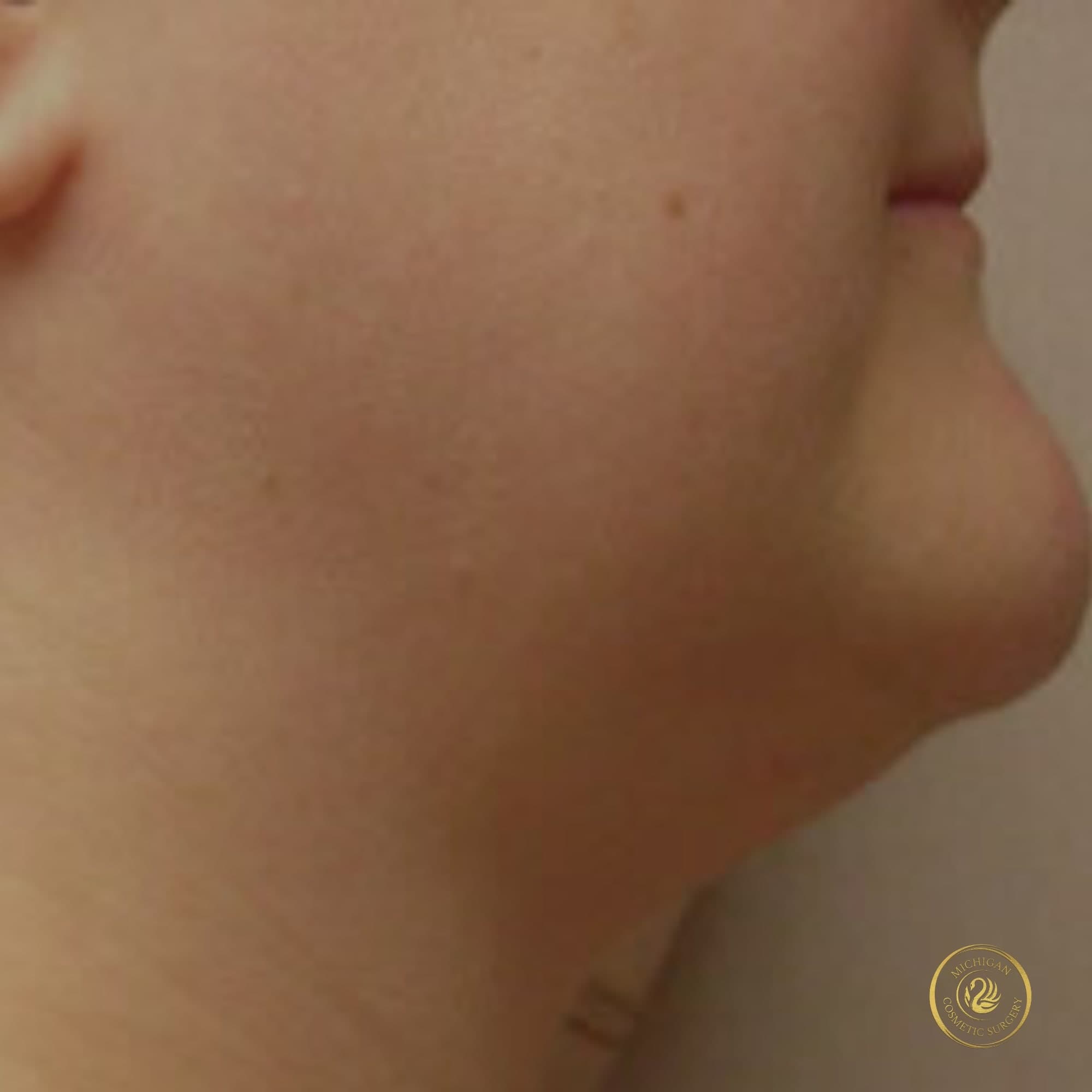 chin liposuction after photo by michigan cosmetic surgery in southfield mi