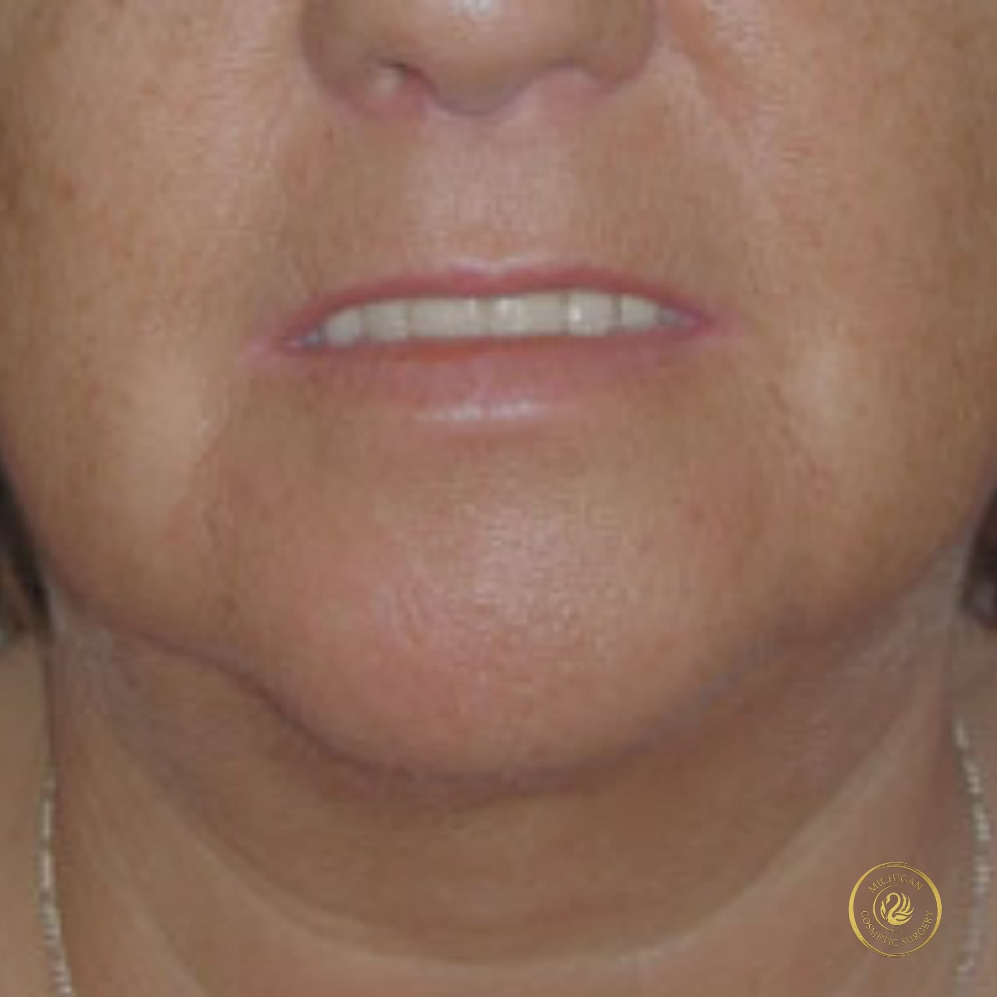 chin liposuction after photo by michigan cosmetic surgery in southfield mi