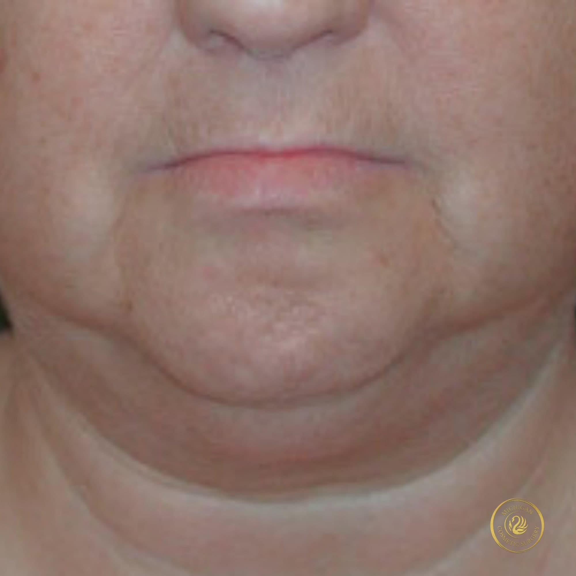 chin liposuction before photo by michigan cosmetic surgery in southfield mi