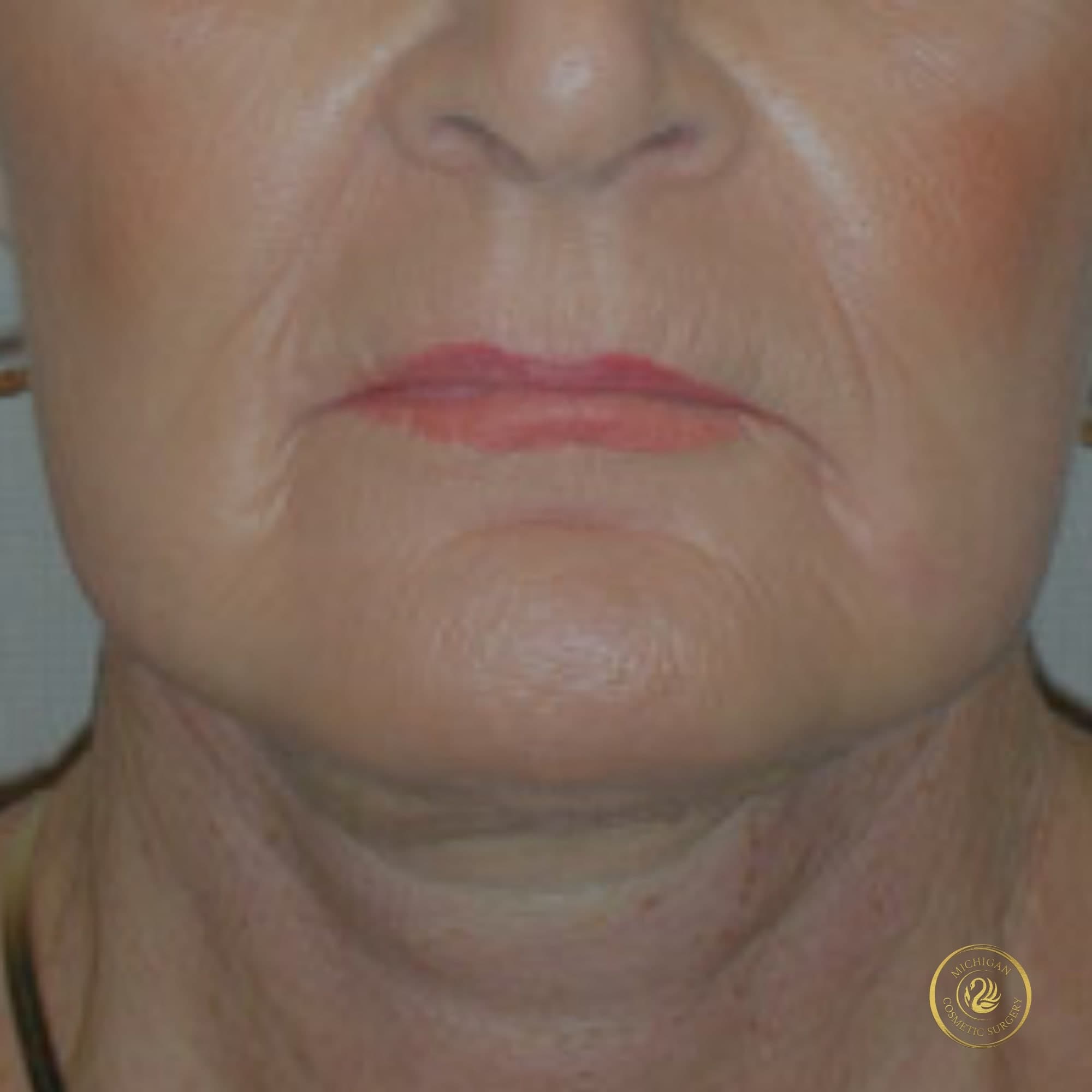 facelift after photo by michigan cosmetic surgery in southfield mi