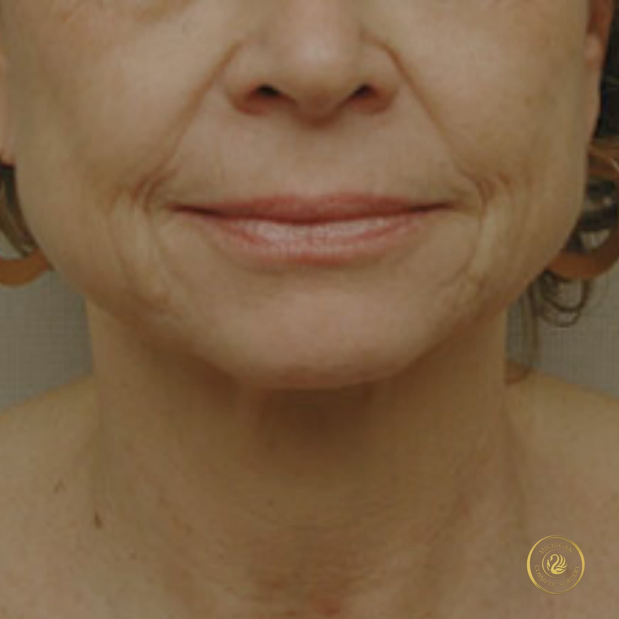 facelift before photo by michigan cosmetic surgery in southfield mi