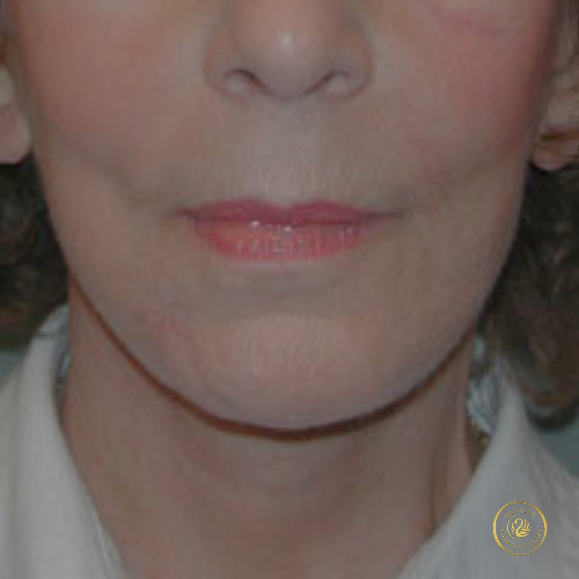 facelift after photo by michigan cosmetic surgery in southfield mi