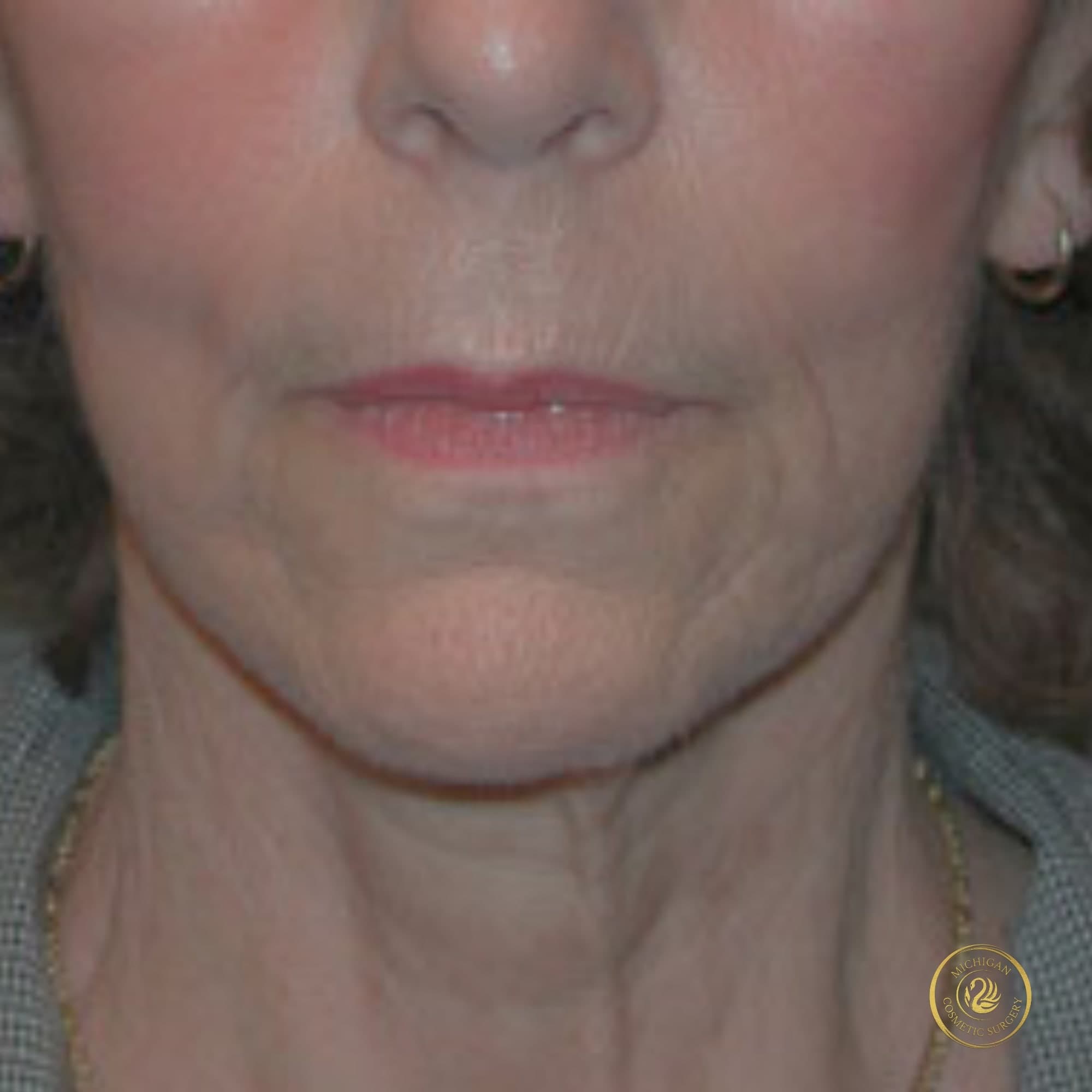 facelift before photo by michigan cosmetic surgery in southfield mi