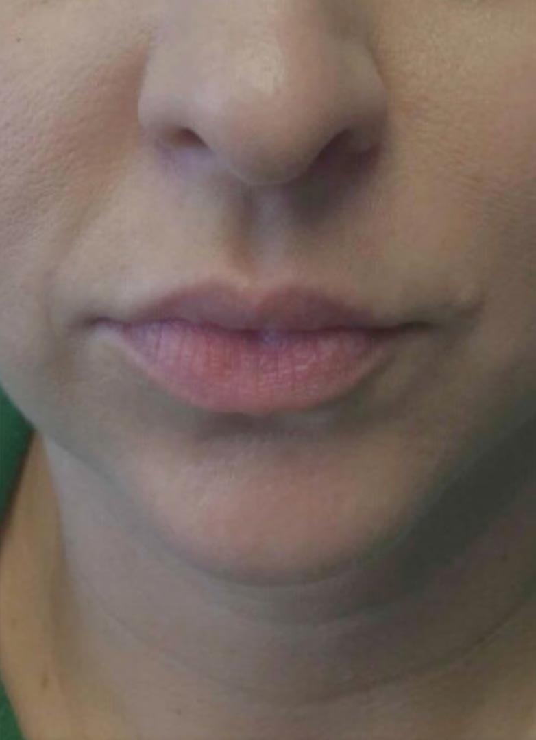 filler before photo by michigan cosmetic surgery in southfield mi