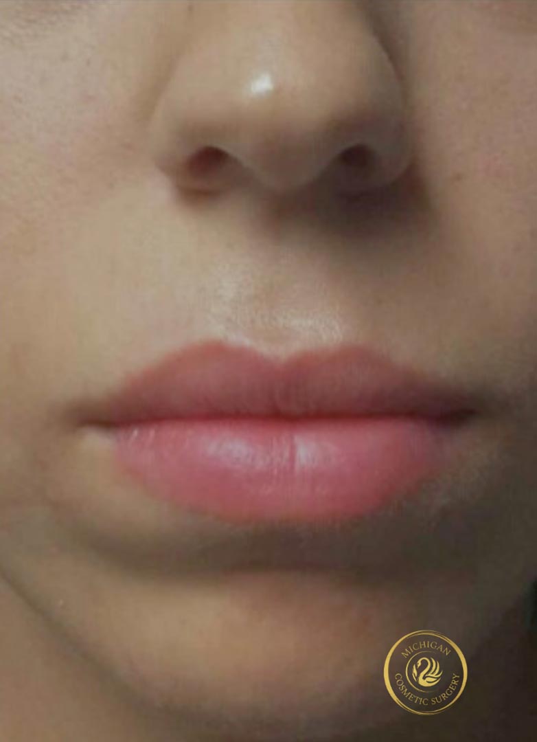 filler after photo by michigan cosmetic surgery in southfield mi
