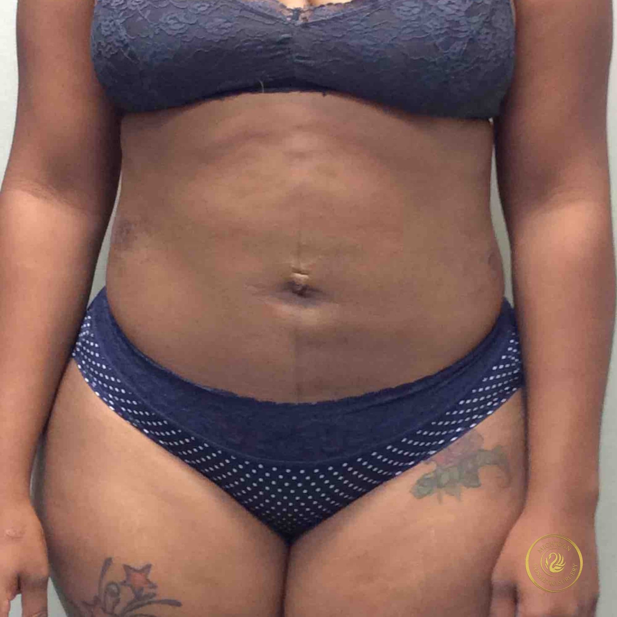 liposuction after photo by michigan cosmetic surgery in southfield mi