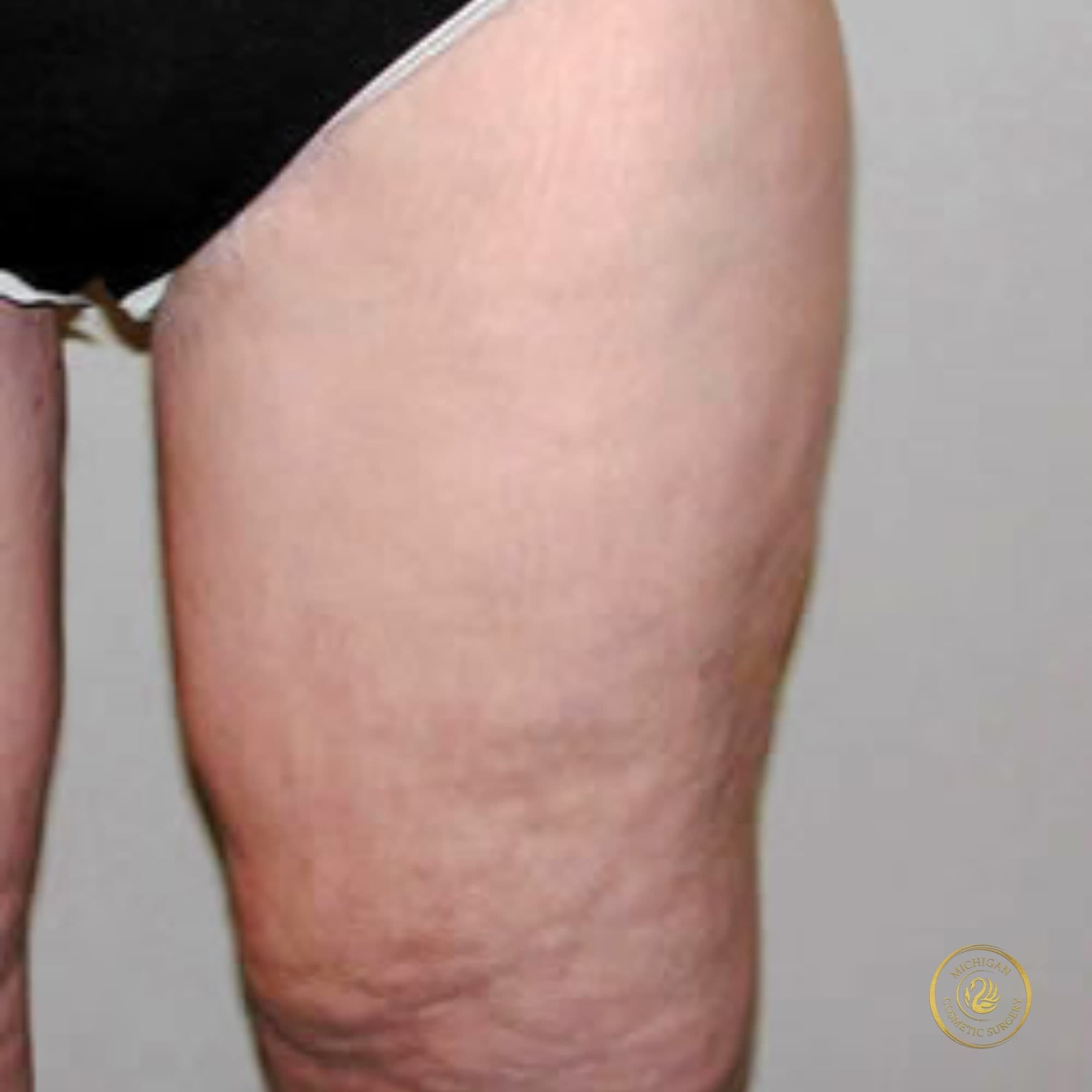thigh lift after photo by michigan cosmetic surgery in southfield mi