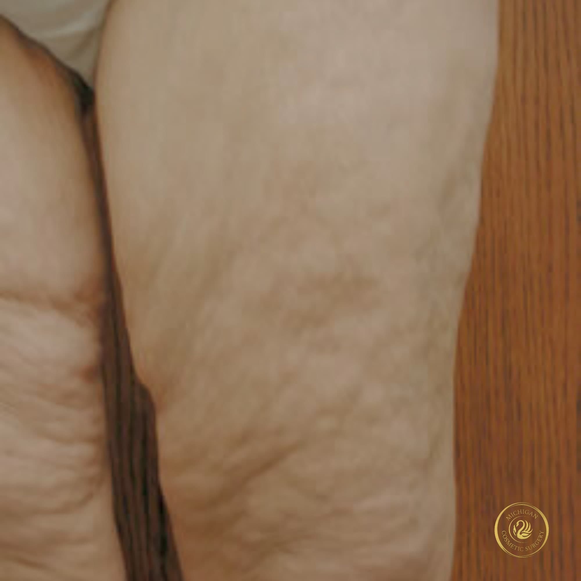 thigh lift before photo by michigan cosmetic surgery in southfield mi