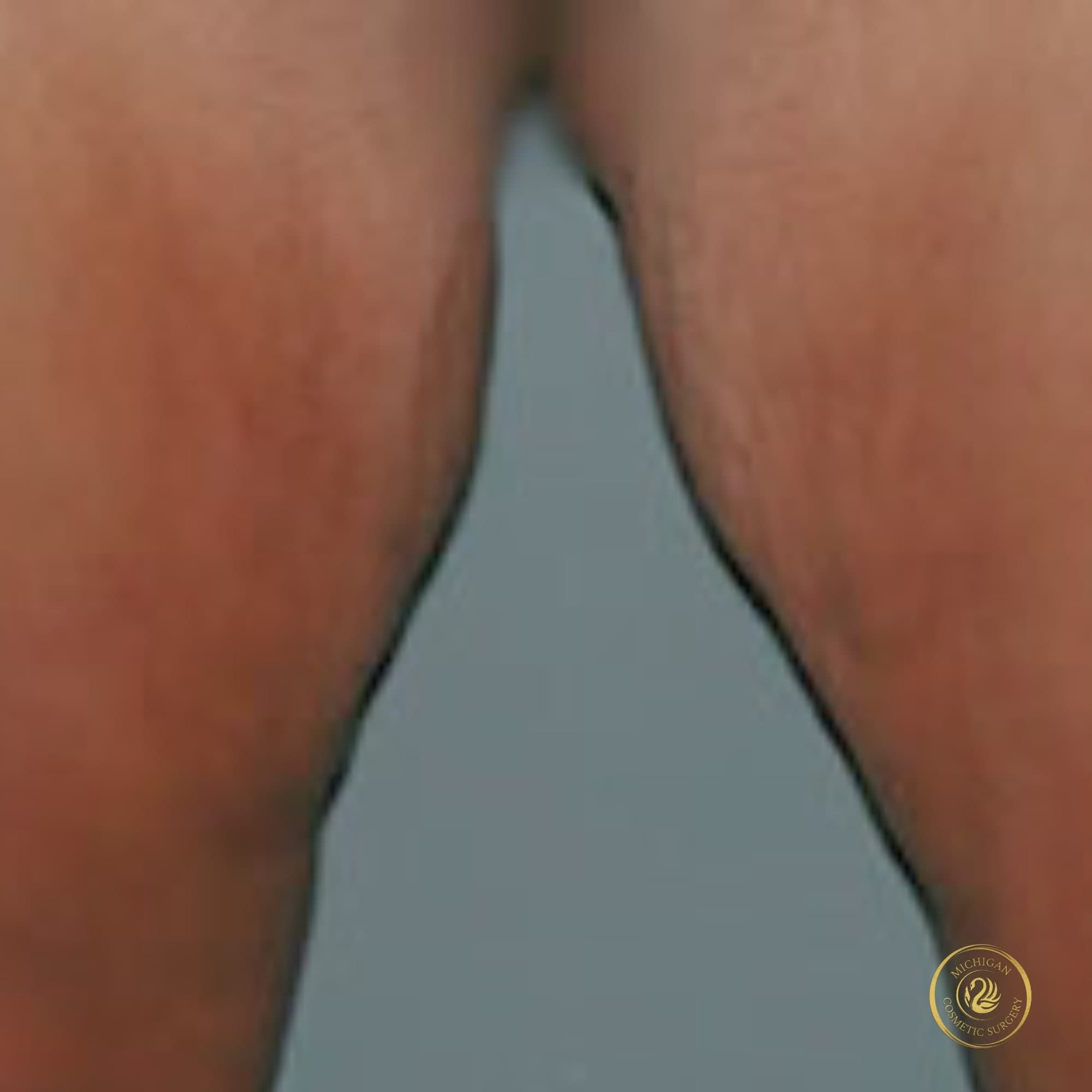 thigh lift after photo by michigan cosmetic surgery in southfield mi