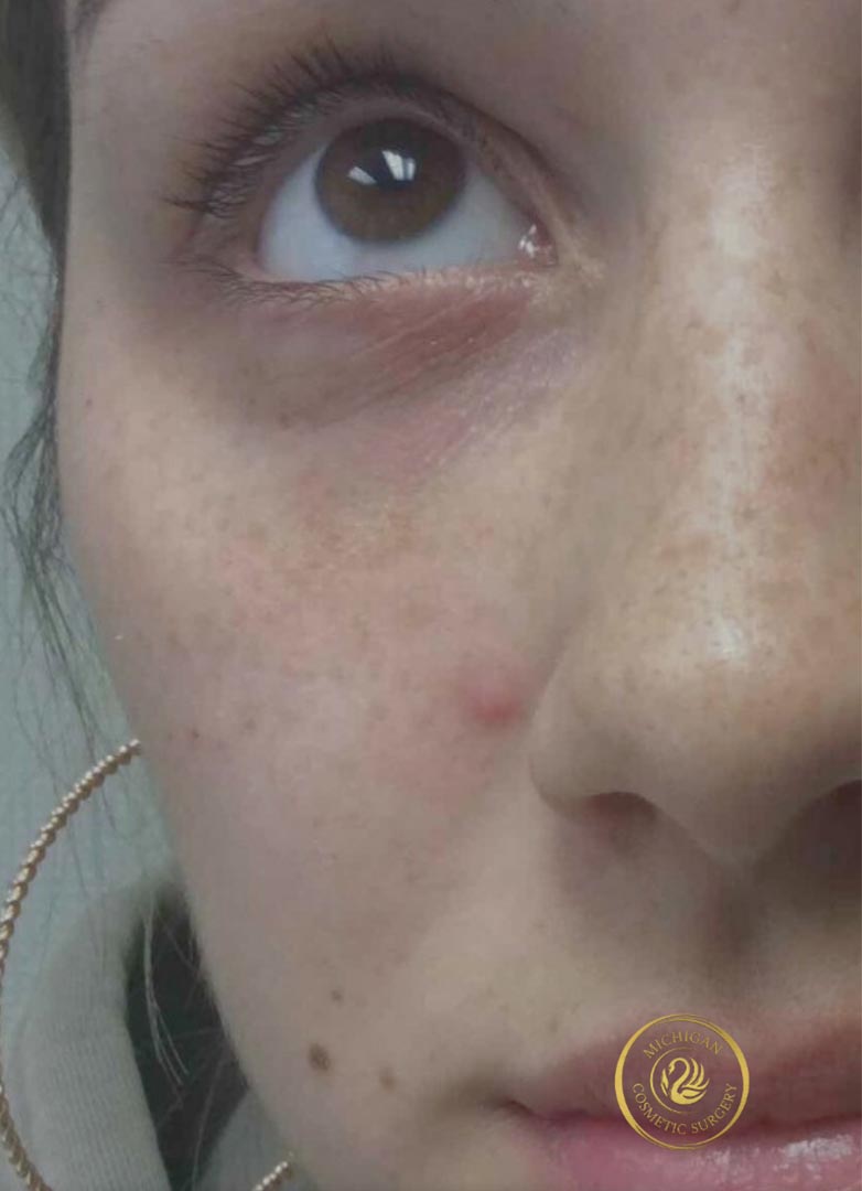 filler after photo by michigan cosmetic surgery in southfield mi