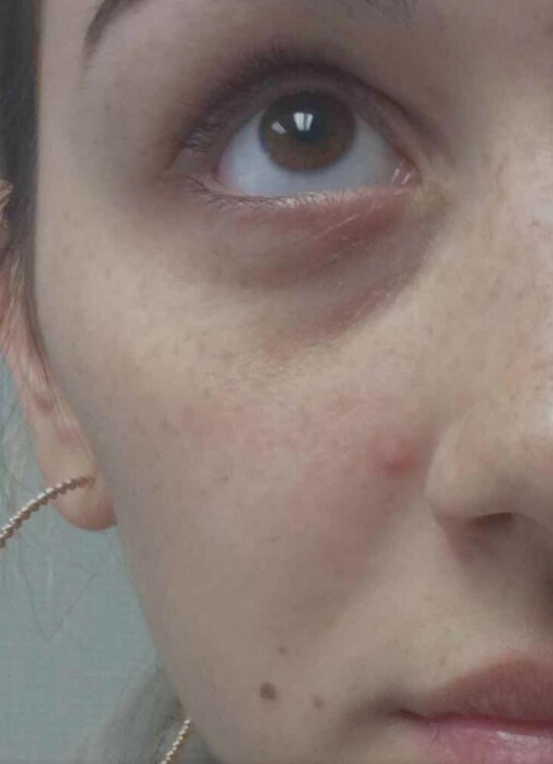 filler before photo by michigan cosmetic surgery in southfield mi