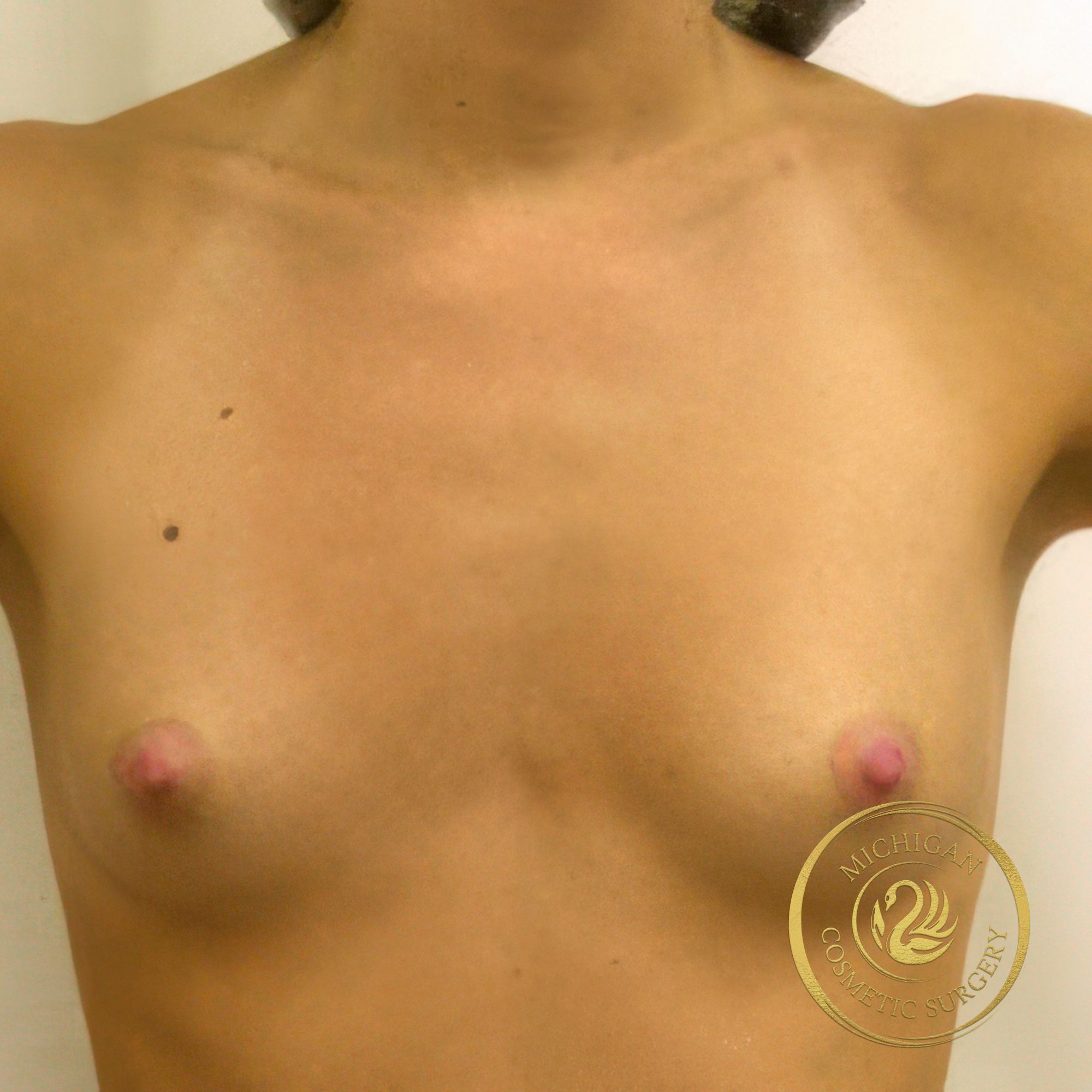 breast augmentation before photo by michigan cosmetic surgery in southfield mi