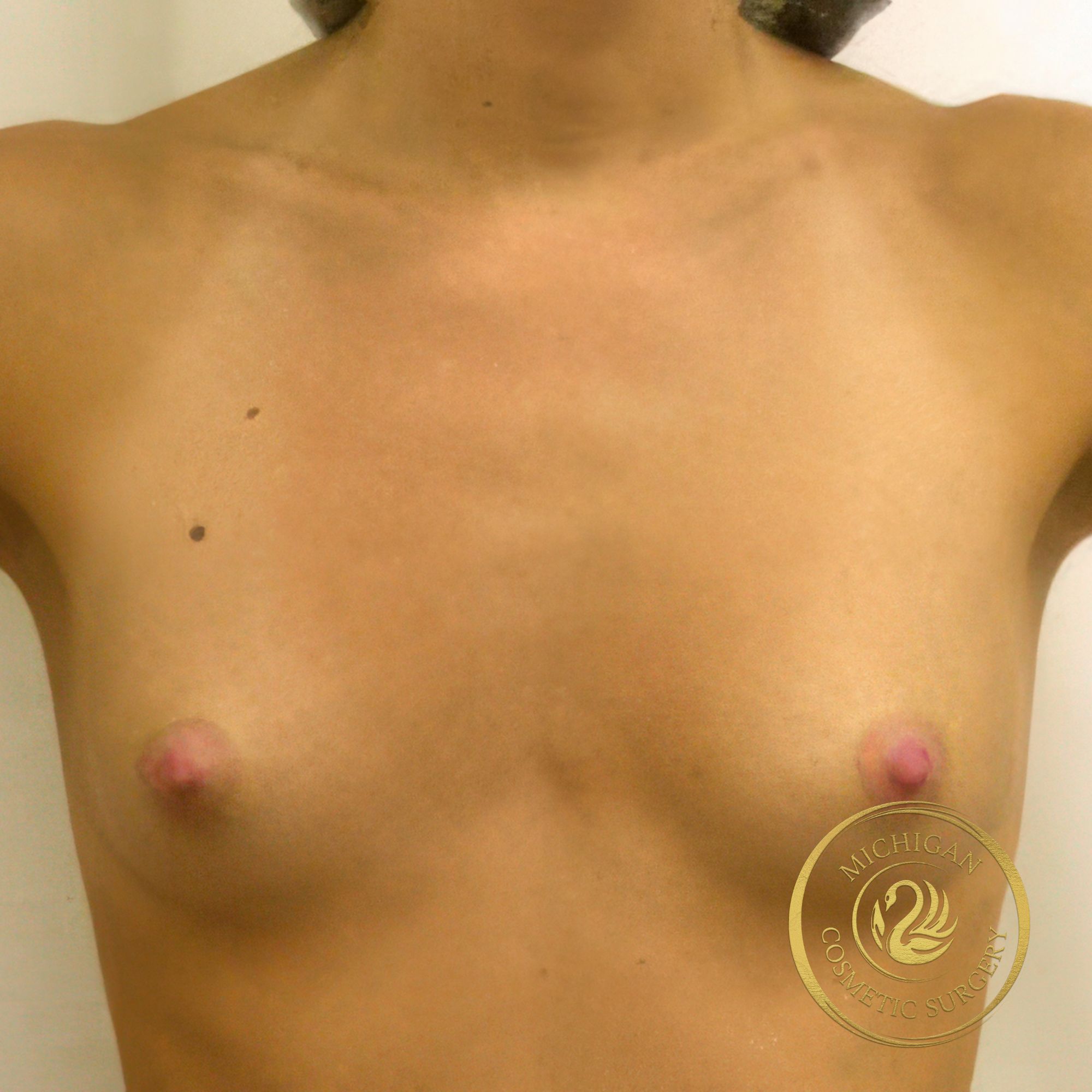 breast augmentation before photo by michigan cosmetic surgery in southfield mi
