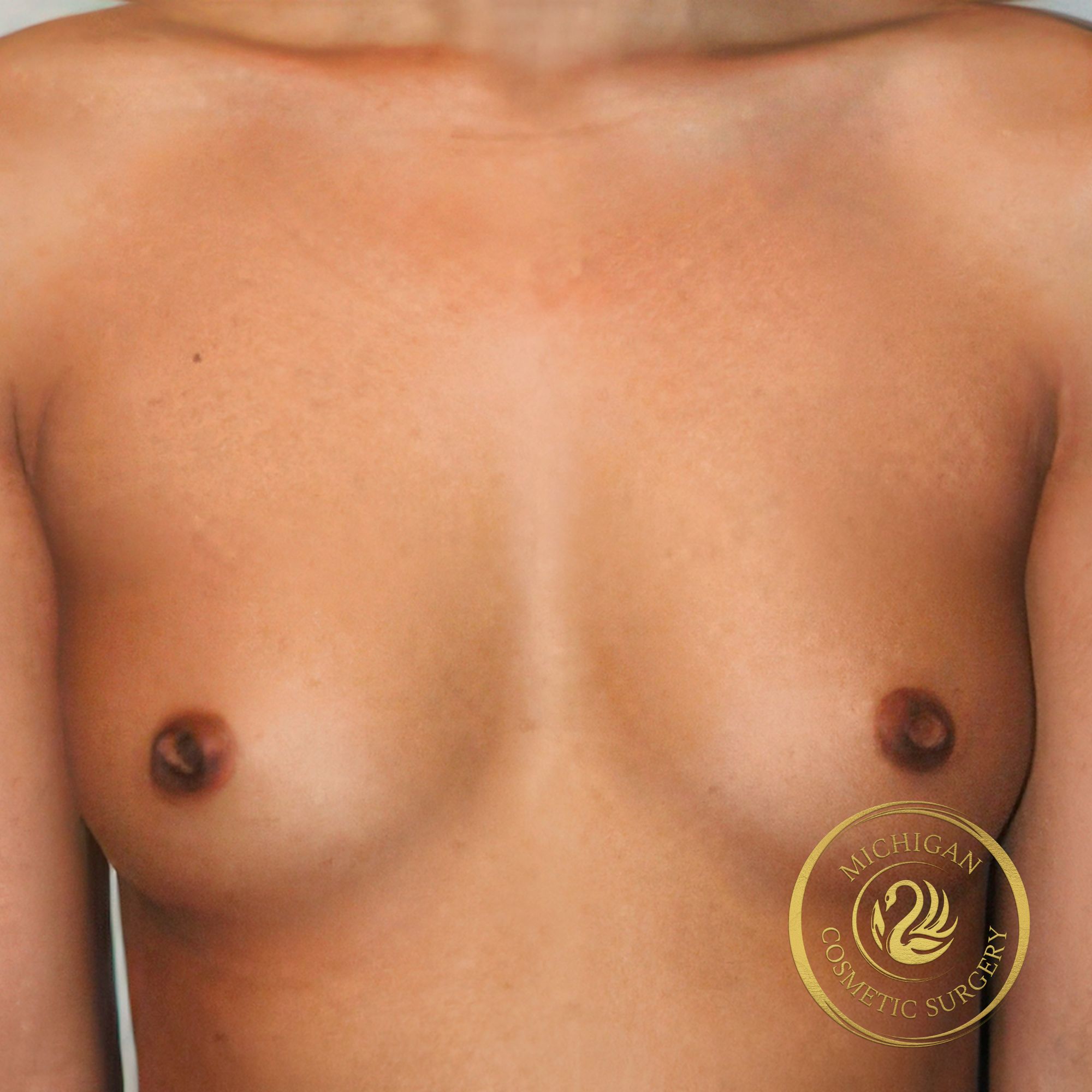 breast augmentation before photo by michigan cosmetic surgery in southfield mi