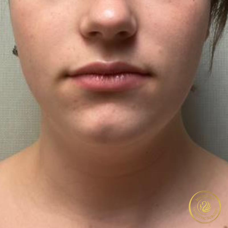 chin liposuction before photo by michigan cosmetic surgery in southfield mi
