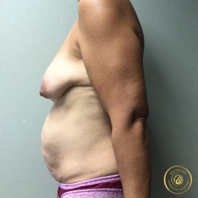 mommy makeover before photo by michigan cosmetic surgery in southfield mi
