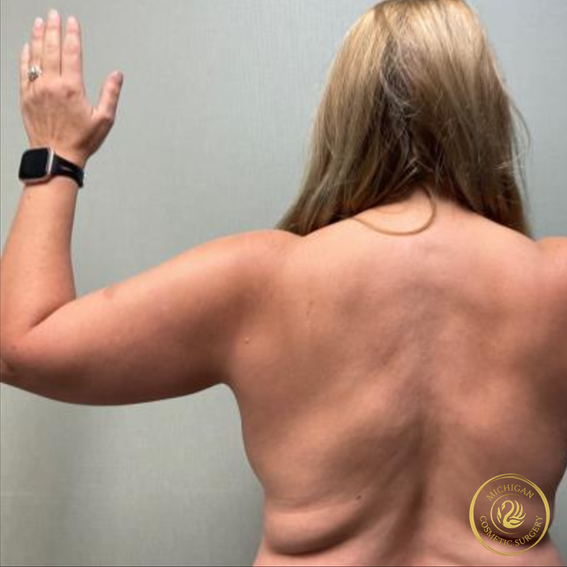 liposuction before photo by michigan cosmetic surgery in southfield mi