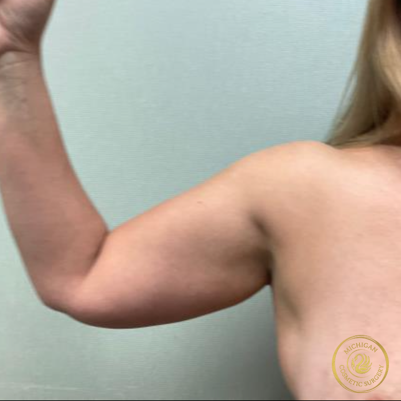 liposuction before photo by michigan cosmetic surgery in southfield mi