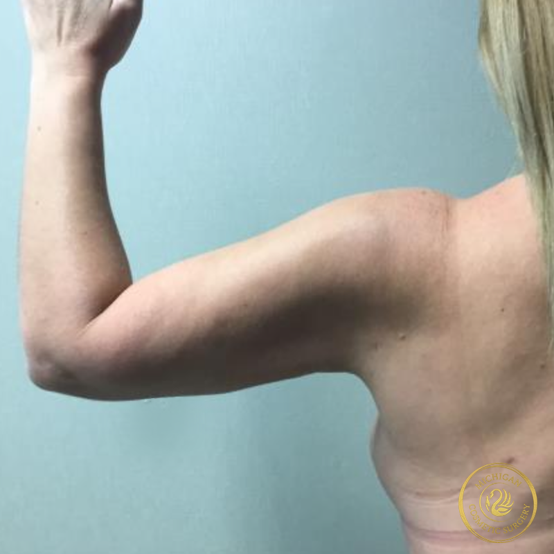 liposuction after photo by michigan cosmetic surgery in southfield mi