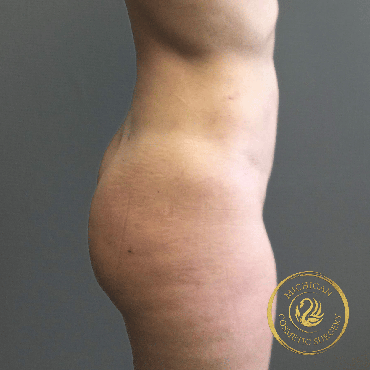 liposuction after photo by michigan cosmetic surgery in southfield mi