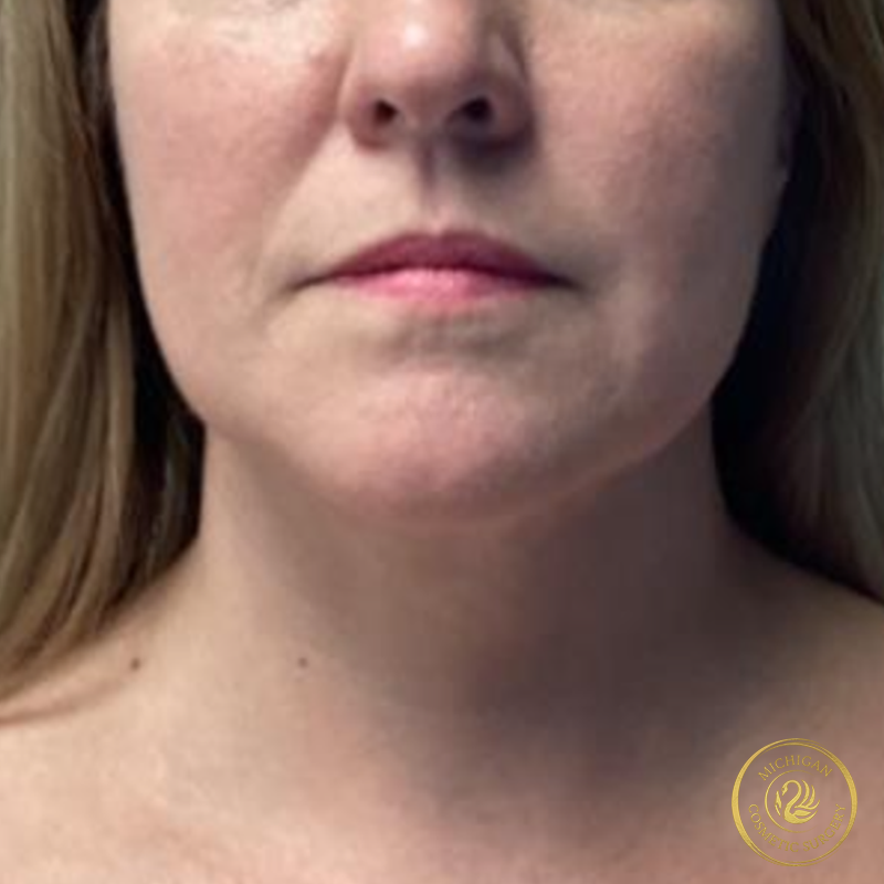 chin liposuction after photo by michigan cosmetic surgery in southfield mi