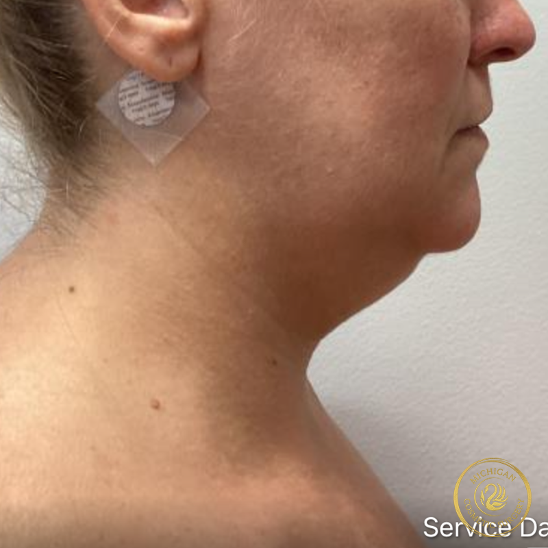 chin liposuction before photo by michigan cosmetic surgery in southfield mi
