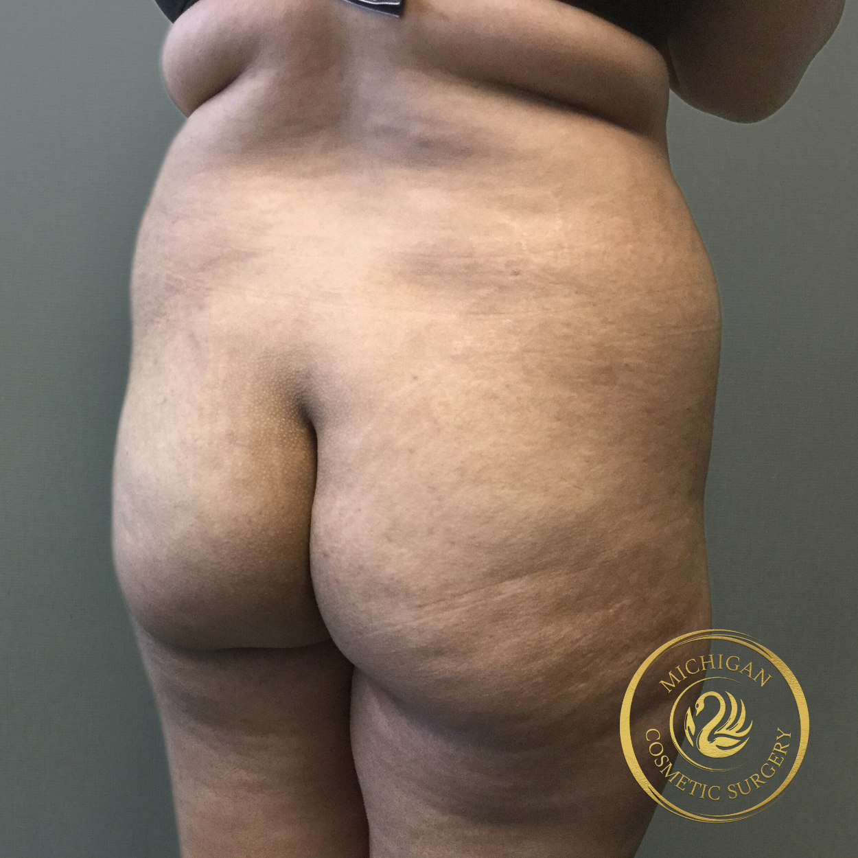 liposuction before photo by michigan cosmetic surgery in southfield mi