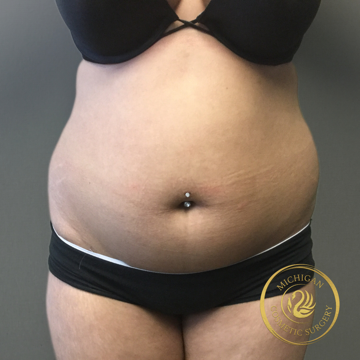 liposuction before photo by michigan cosmetic surgery in southfield mi