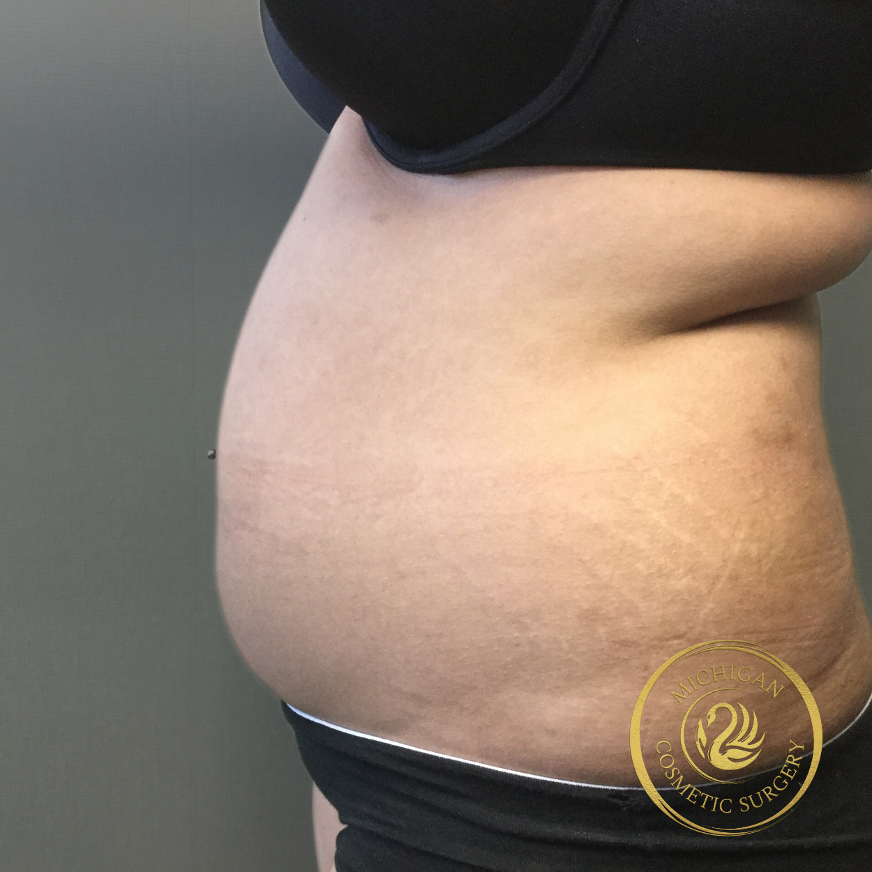 liposuction before photo by michigan cosmetic surgery in southfield mi