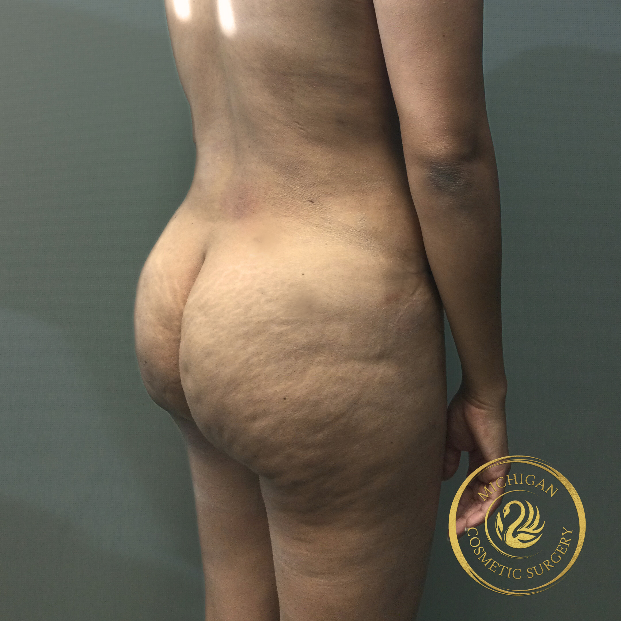 brazilian butt lift after photo by michigan cosmetic surgery in southfield mi