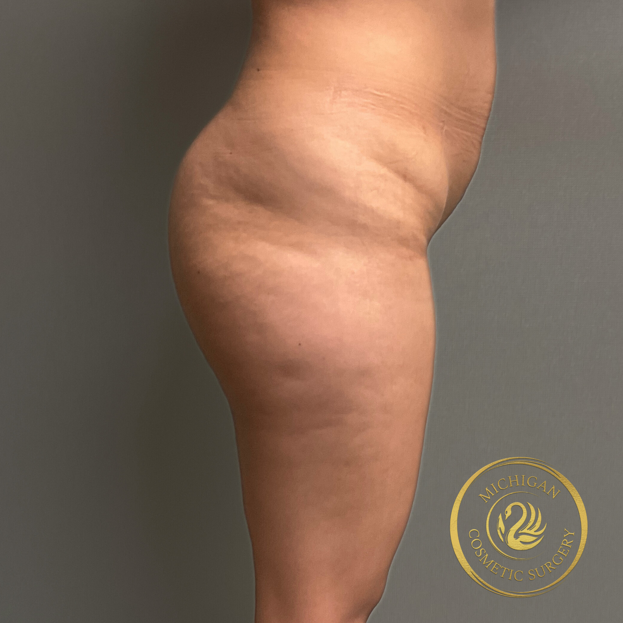 brazilian butt lift before photo by michigan cosmetic surgery in southfield mi