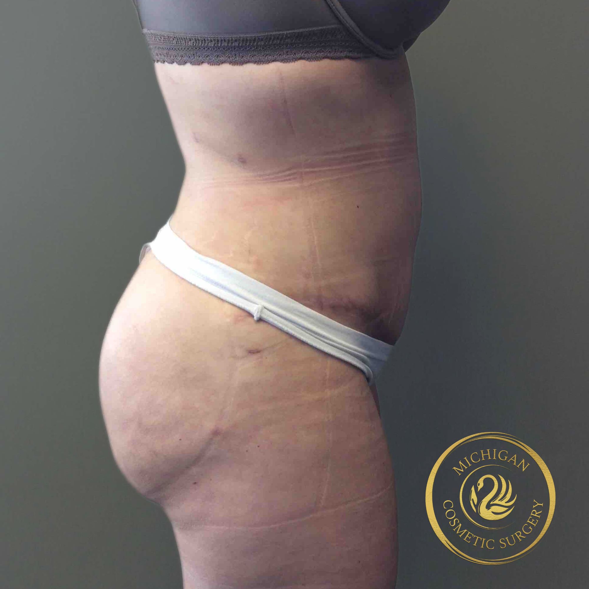 brazilian butt lift after photo by michigan cosmetic surgery in southfield mi